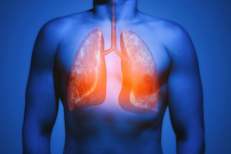 Lung Cancer Screening