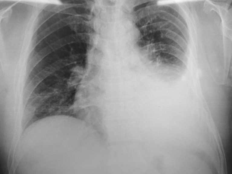 Pleural Effusions
