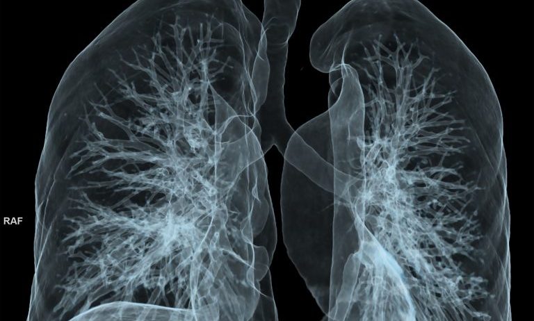 Bronchiectasis
